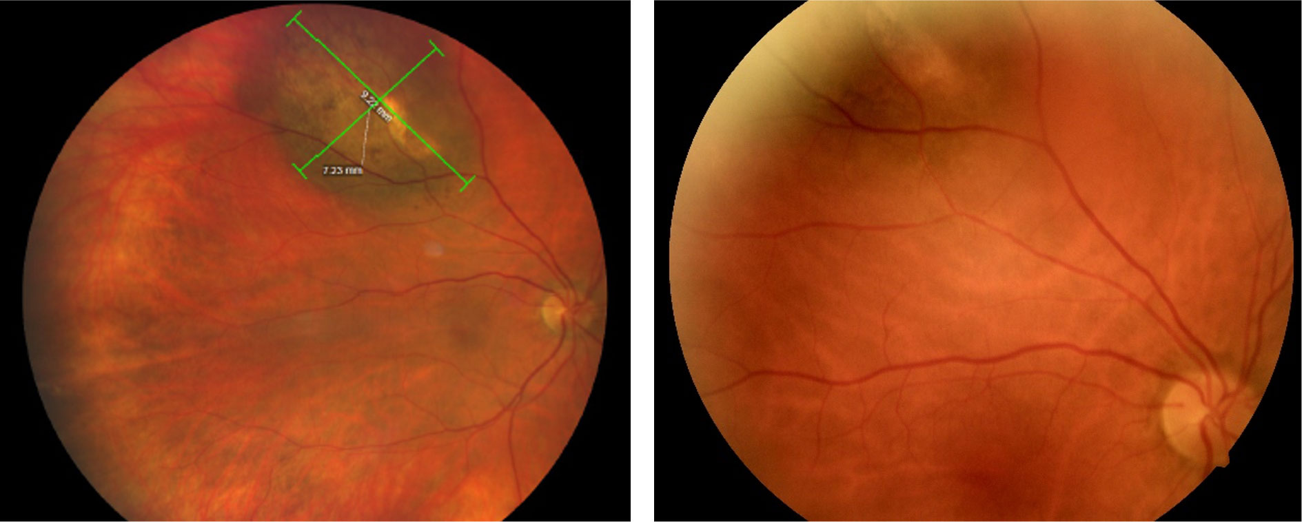 Figure 1a: (Left) Wide-field color fundus photography of pigmented choroidal tumor of the right eye upon 2020 evaluation.  Tumor size measured 9.22mm x.7.23mm.  Figure 1b: (Right) Standard fundus photography taken 16 months prior (2018) .  Comparison between the two demonstrates obvious expansion of the tumor with the posterior margin now extending past the venous bifurcation and reaching closer to the optic nerve.