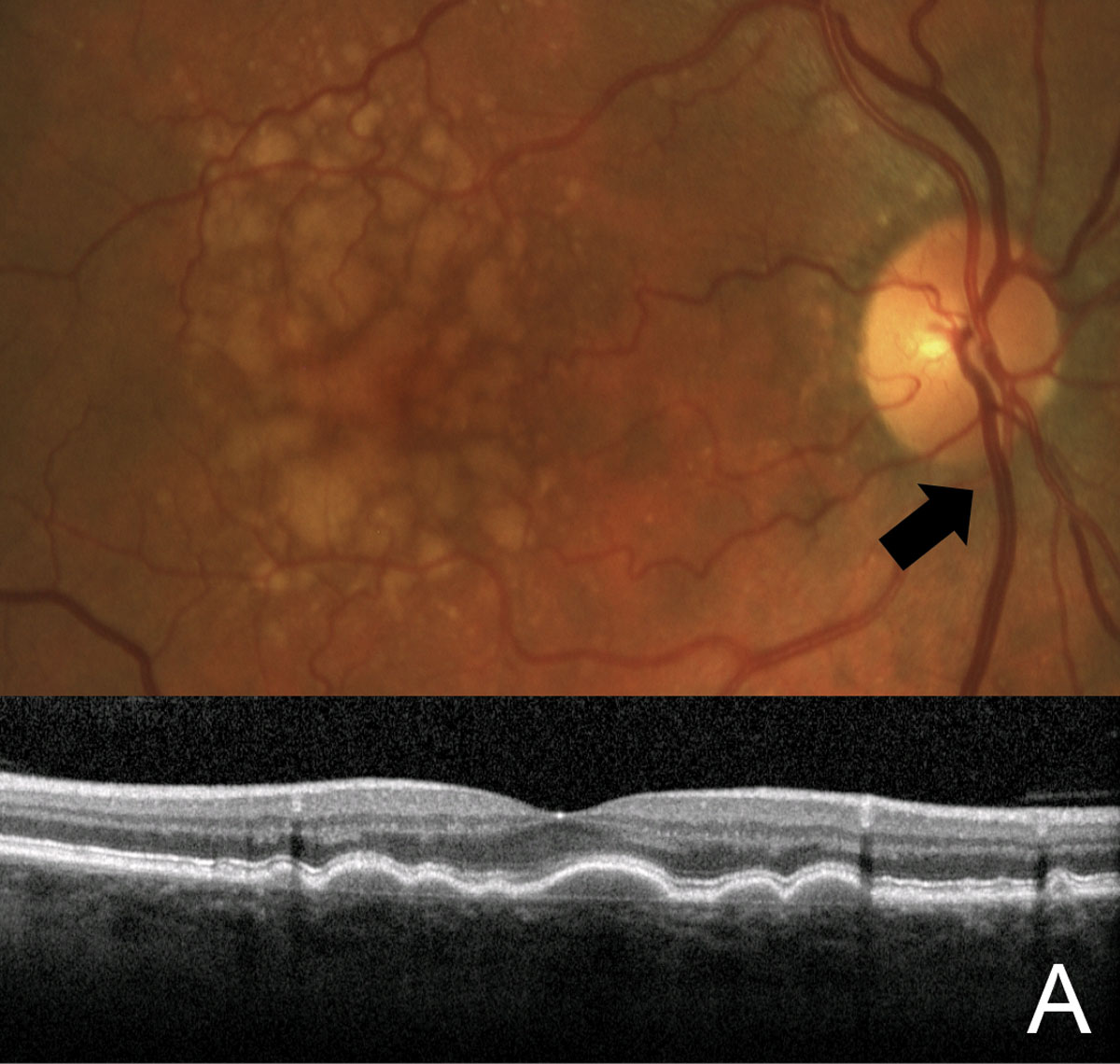 Monitoring dry AMD patients for risk factors for conversion to the wet form (such as the large, soft drusen shown here) is an ideal role for optometric skills in the continuum of retina care.