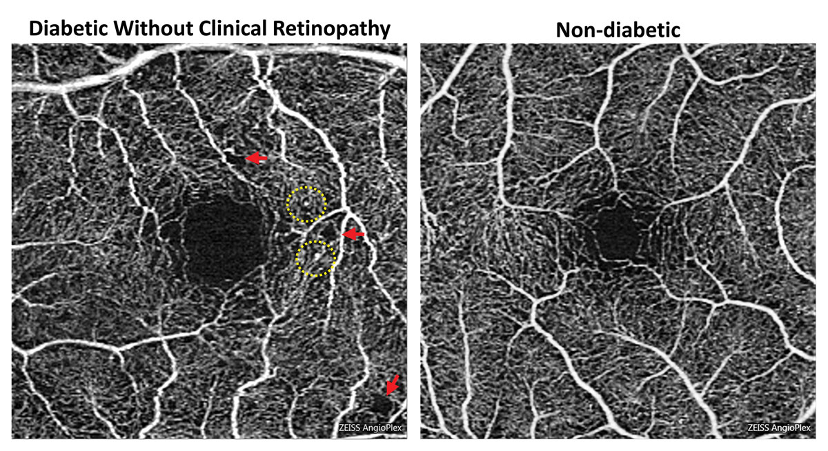 New technology is elevating the importance of early diagnosis and, with it, the profile of optometrists equipped to do so. These OCT-A images show foveal enlargement and perifoveal capillary remodeling in a diabetic eye without funduscopically visible diabetic retinopathy. Red arrows point to subtle areas of capillary nonperfusion while yellow circles highlight microaneurysms.