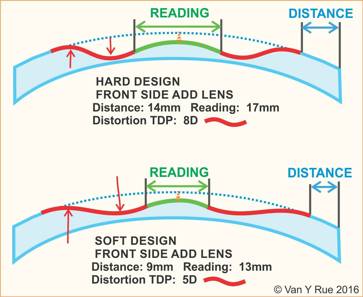 “Hard” and “soft” are the two main categories of progressive lens design. Both refer to the amount of blur located at the peripheral blending zones. Soft lenses spread the blending zones out into the distance and reading portions of the lens.
