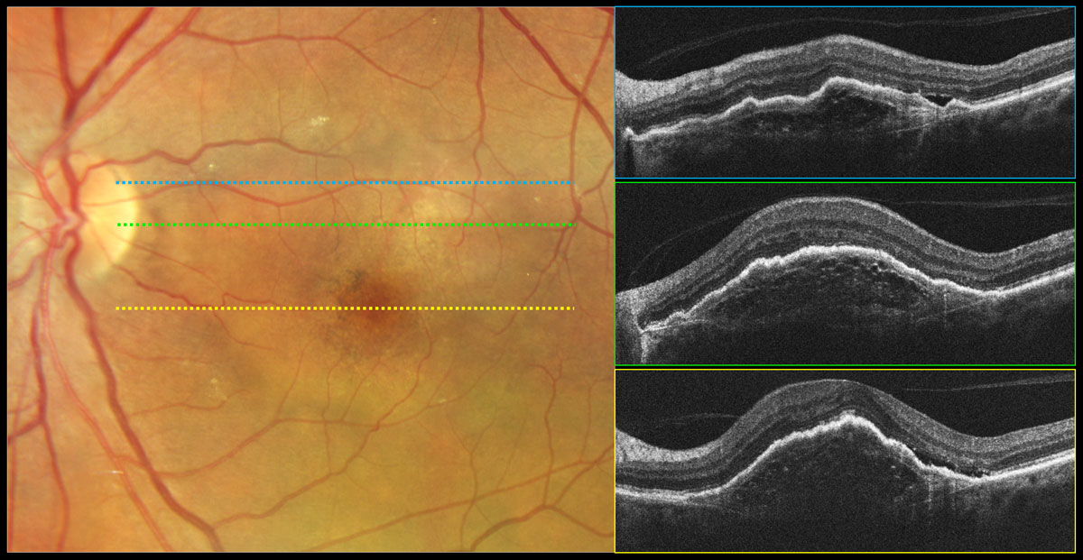Fig. 3. Type 1 neovascular exudative AMD, fibrovascular PED. Color photography shows a round lighter area of the macula that is elevated corresponding to a fibrovascular PED with overlying pigmentary changes. OCT reveals a PED with irregular surface contour and variable (nonhomogeneous) internal reflectivity containing multilaminate hyperreflective sheets. Bruch’s membrane can be visualized as a thin hyperreflective line at the base of the PED. Subretinal fluid is present on the temporal aspect of the PED likely due to exudation vs. mechanical stress.
