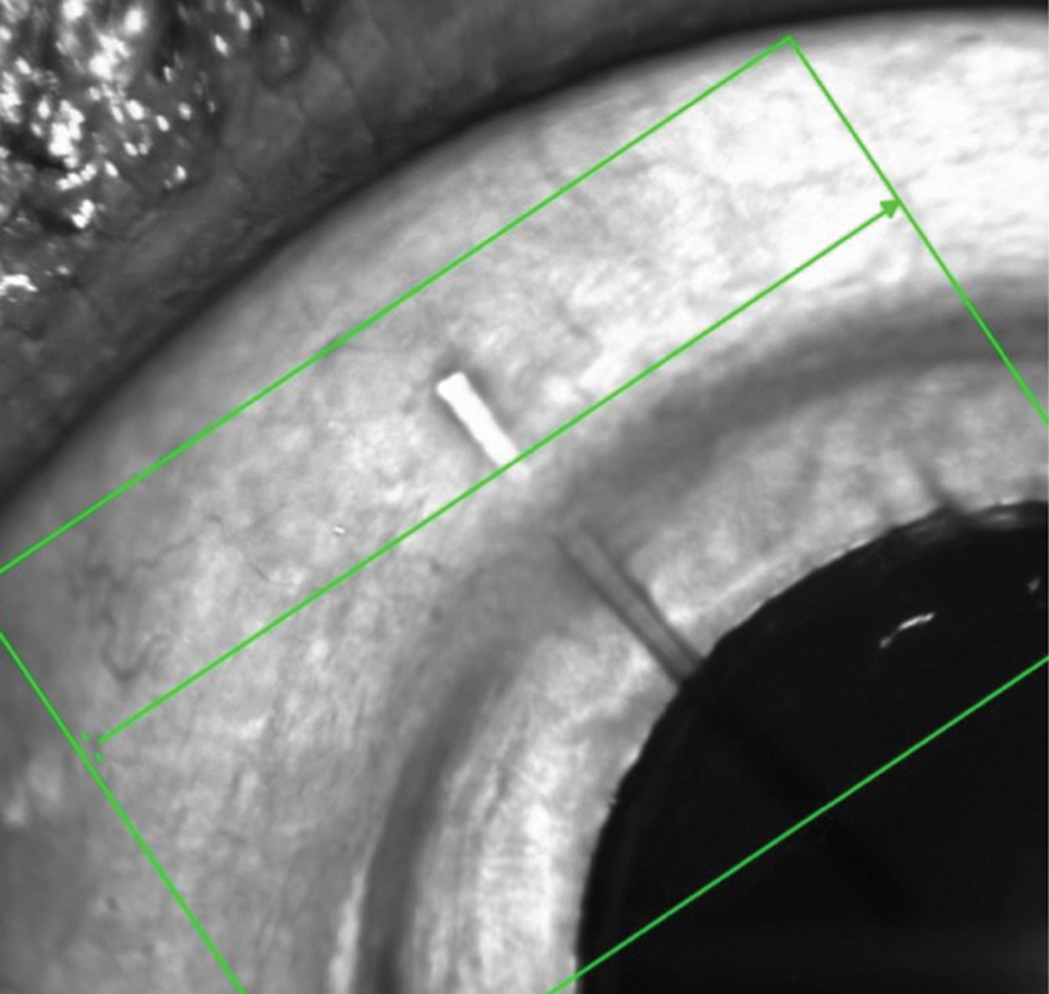 This MIGS device is designed to facilitate drainage of aqueous from the anterior chamber into the subconjunctival space.
