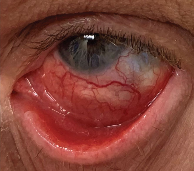 Anterior scleritis in a patient post-surgery.