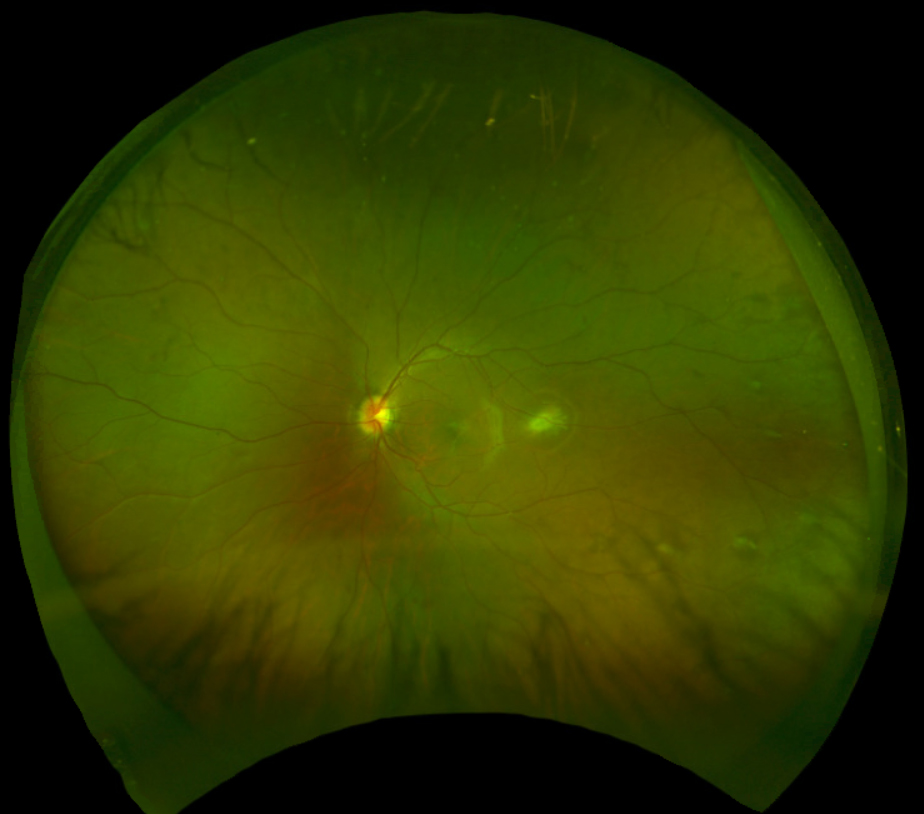 Fig. 2. Fundus photograph of the left eye captured with Optos.