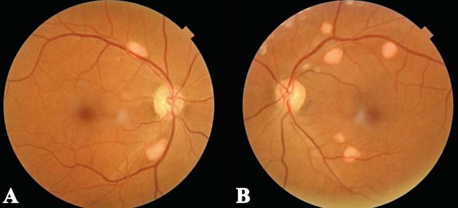 Fundus photos of both eyes (right eye: A; left eye: B) show scattered elevated, orange-yellow lesions with distinct borders, located along the superotemporal and inferotemporal retinal vascular arcades within the posterior pole. 