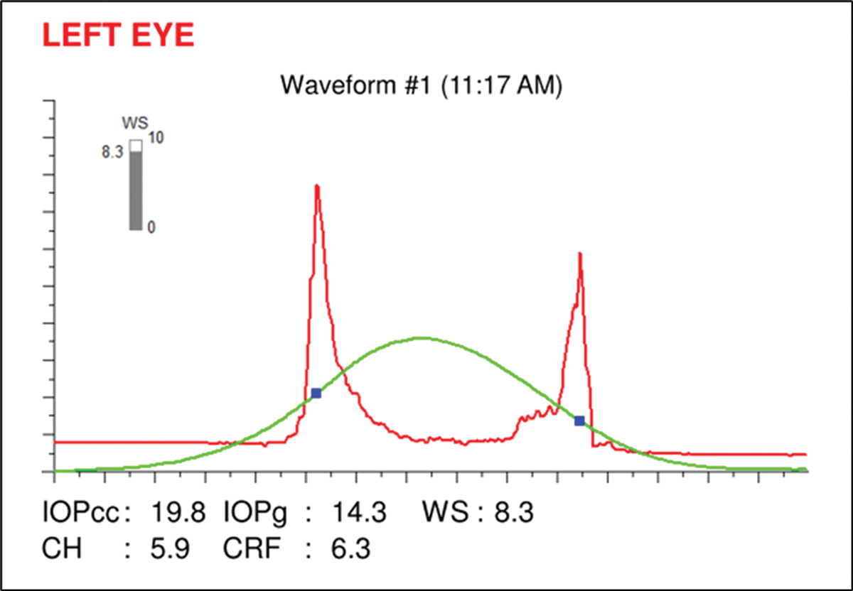 Fig. 10. Ocular Response Analyzer readout showing a corneal hysteresis measurement of 5.9, which is low.