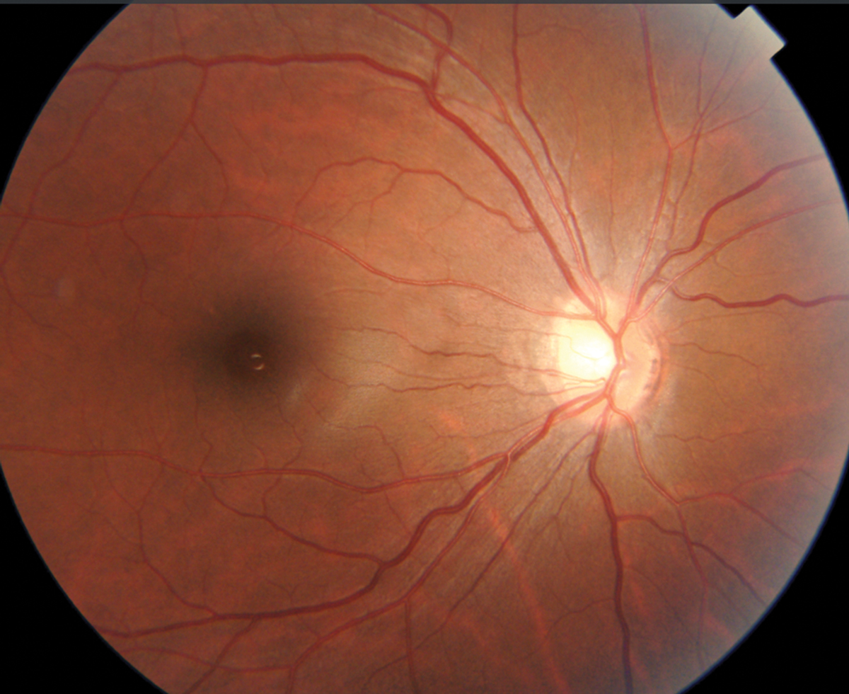 Fig. 19. Disc photo of high myope with large, indistinct cup.