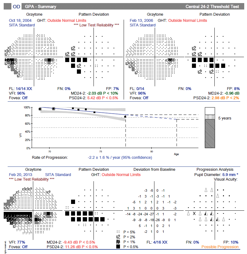 Fig. 25. Visual field progression analysis showing advancing loss.