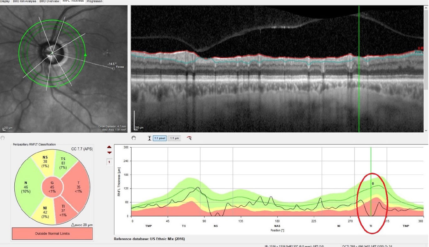 Thinning of the perioptic RNFL OS, with complete loss of the RNFL in one small sector inferotemporally. This area coincides with the thinned neuroretinal rim in the first image.