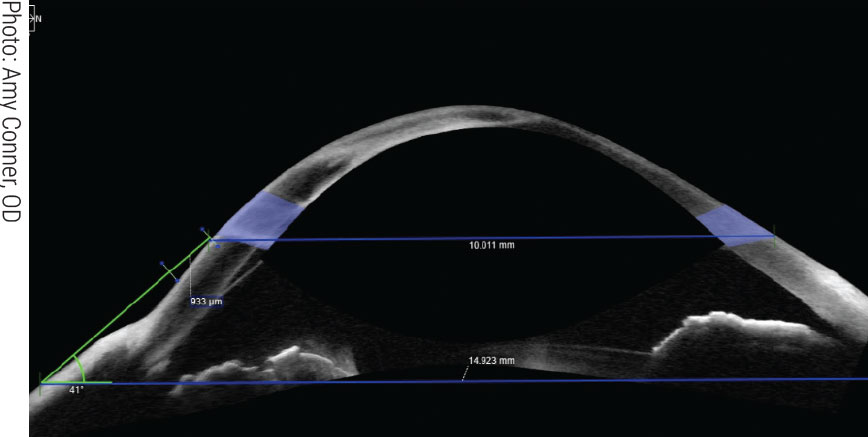 ODs who offer specialty lens fits typically have access to advanced equipment like anterior segment OCT, allowing for more precise results.