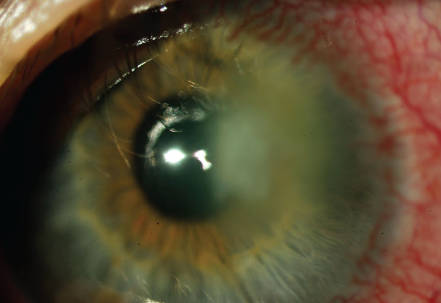 Take note of any anterior chamber reaction, which can occur in the presentation of FK.