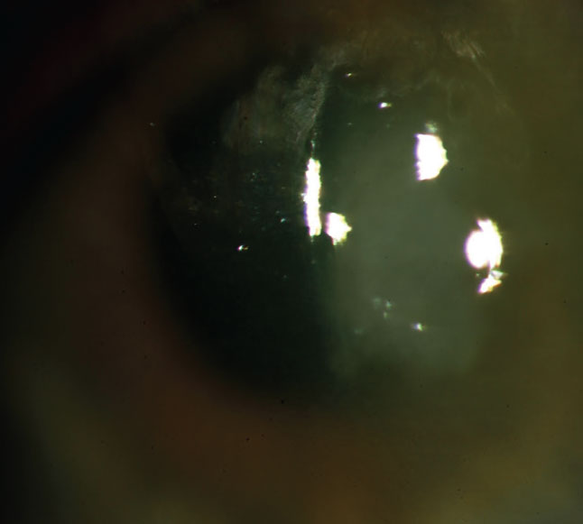 FK can lead to corneal scarring, glaucoma and endophthalmitis.