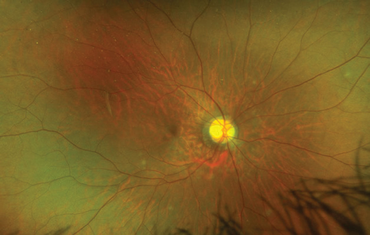 Fig. 1. Look carefully around the optic nerve and inferior arcade in this patient’s right eye.