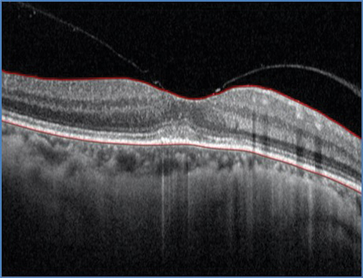 SD-OCT through the macula of the left eye. What does it show?