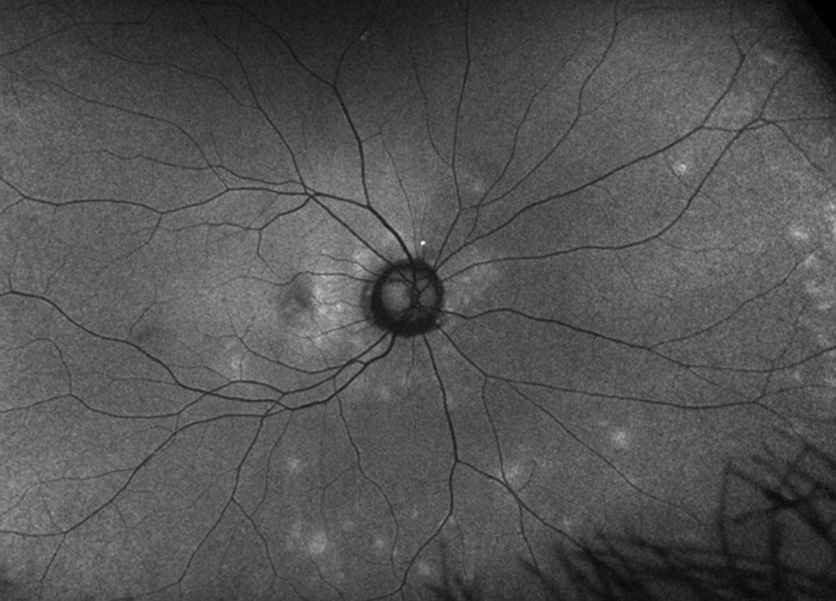 Fig. 3. FAF image of the right eye. How is it different than the clinical photo?