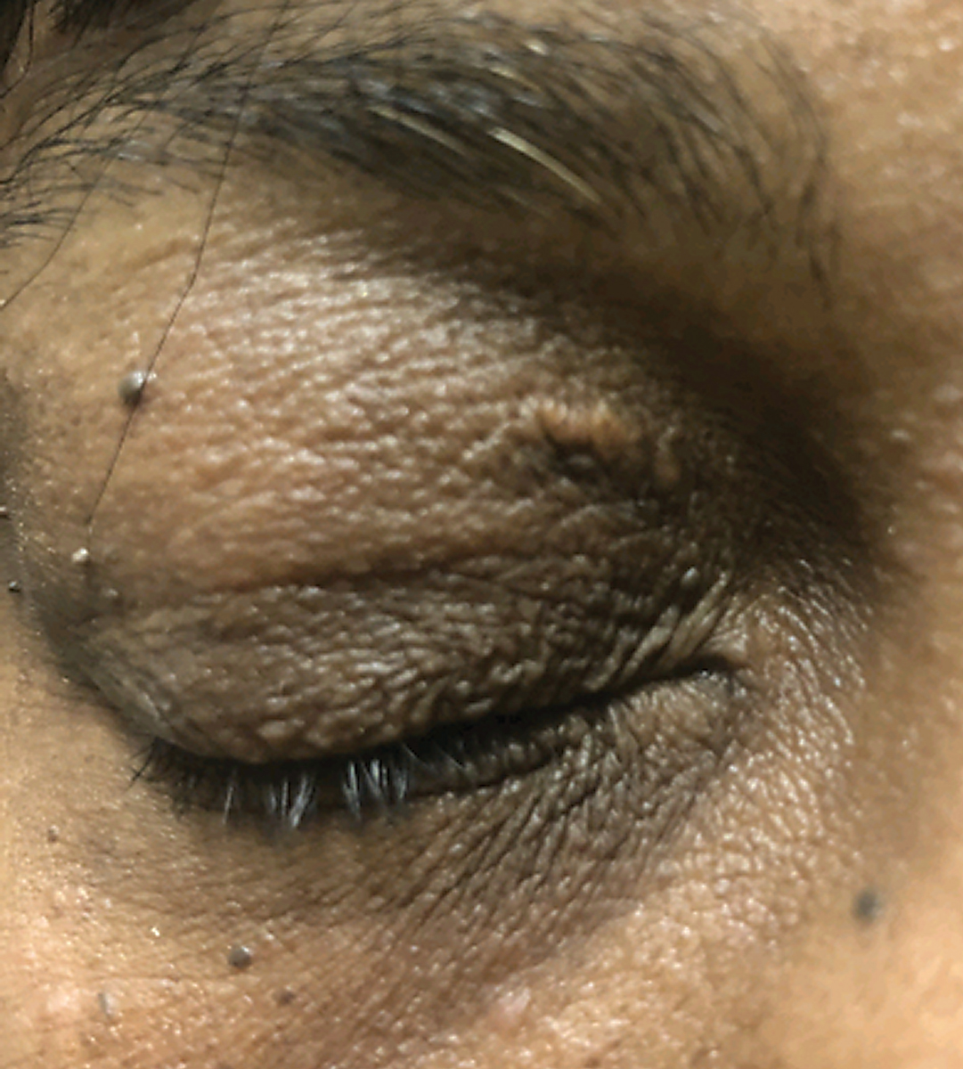 An example of periocular skin findings similar to those of the patient in question.