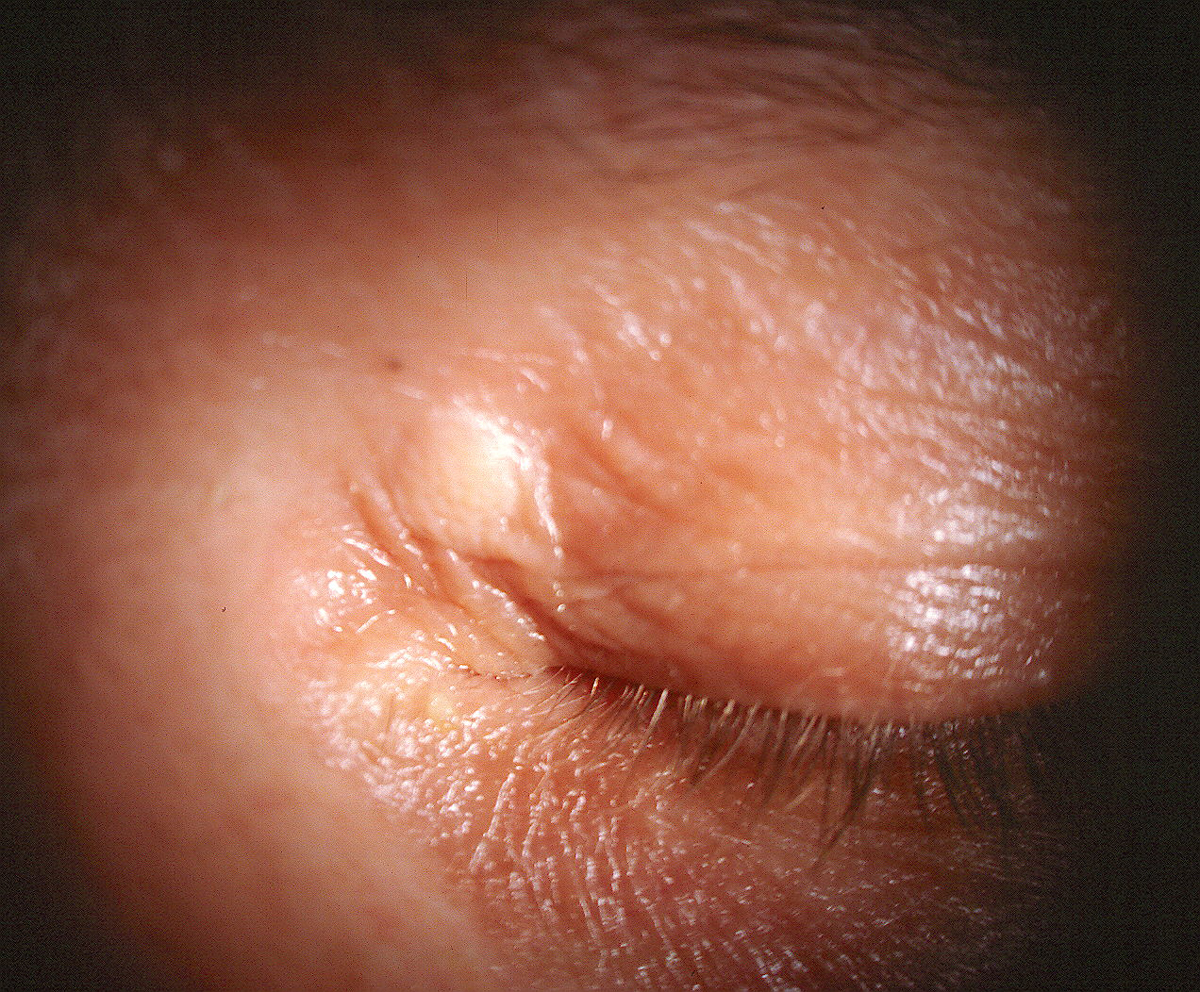 Another example of periocular skin findings similar to those of the patient in question.