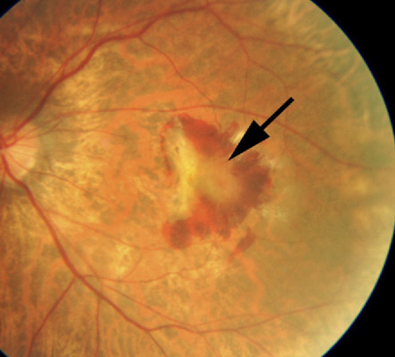 Macular hemorrhage and fibrovascular membrane in a 67-year-old highly myopic female. Photo: Ophthalmology, 2010. 