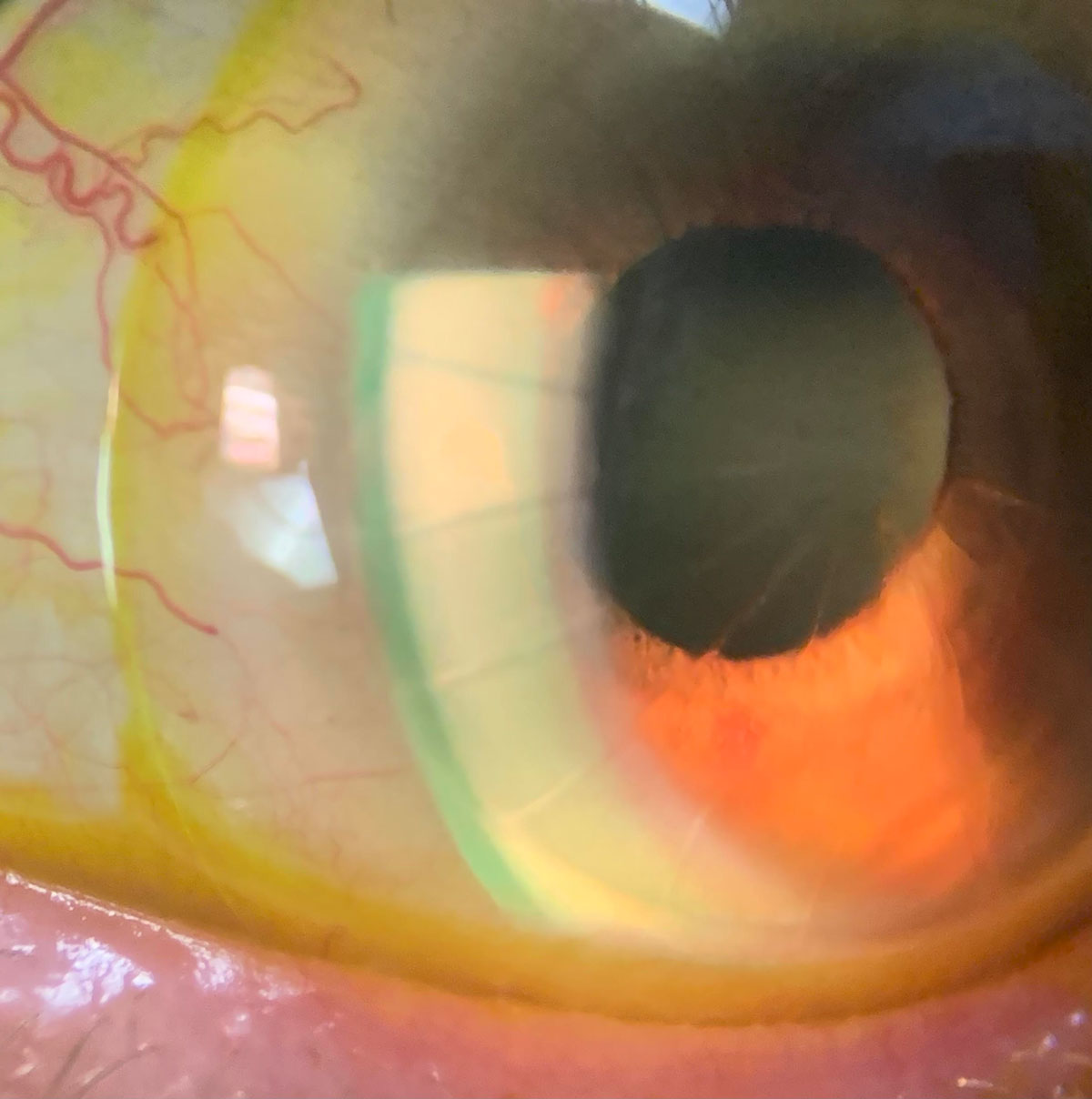 A scleral with sodium fluorescein on an eye with radial keratectomy, Acanthamoeba keratitis and neovascularization.