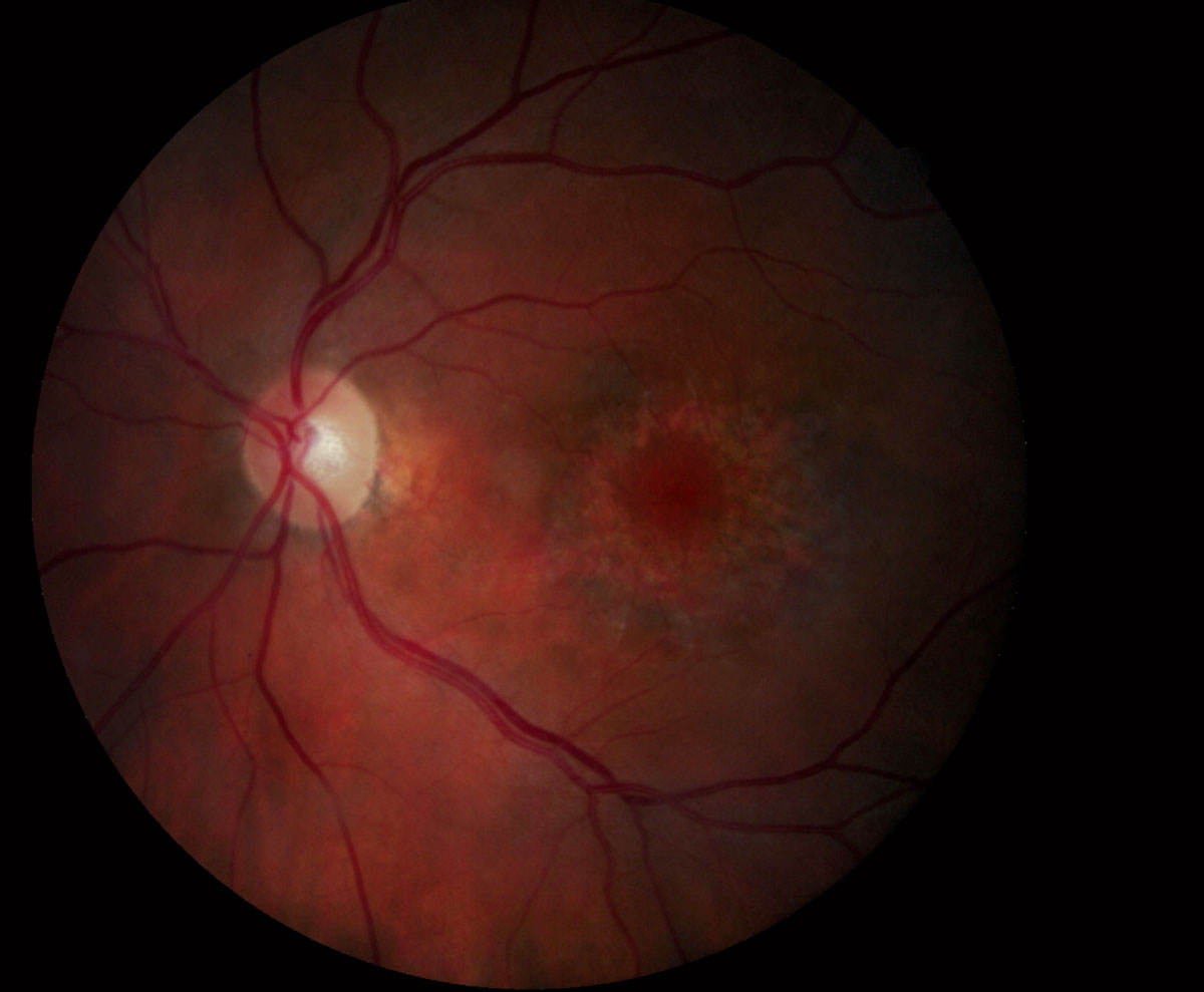 Conventional fundus examination may not always reveal Plaquenil toxicity, seen here. Earlier identification is possible with advance OCT devices. Image courtesy of Marlon Demeritt, OD. 