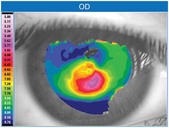 Heating the cornea to induce collagen shrinkage—thermokeratoplasty—seems to work well for KCN patients. 