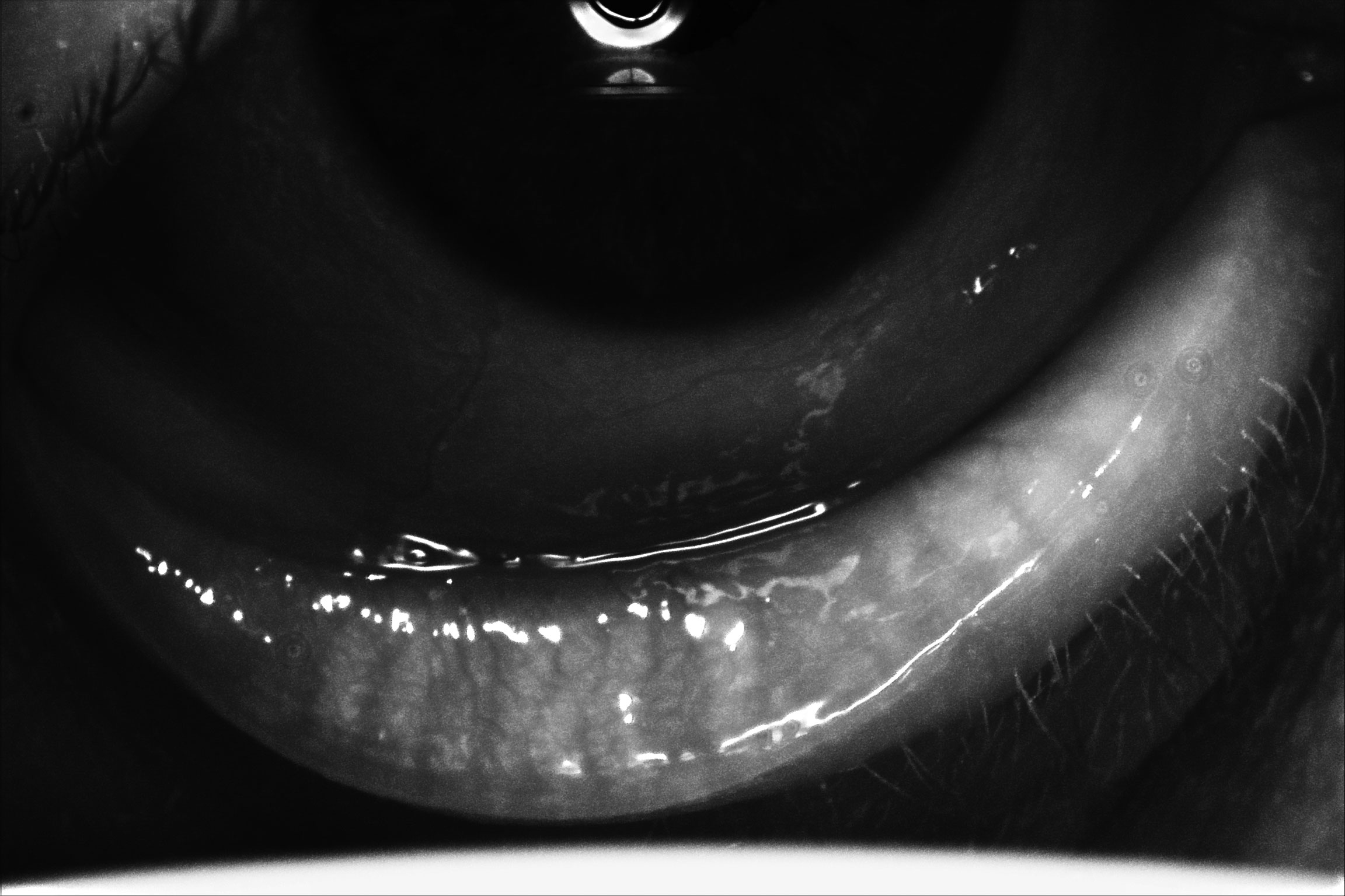 Meibography of a patient with severe dry eye disease. Note they have moderate atrophy of the glands with moderate truncation and loss of gland structure, OS greater than OD.