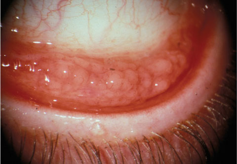 Experts differ on whether or not use of antibiotics is worthwhile in chlamydial conjunctivitis. Photo: Marc Bloomenstein, OD.