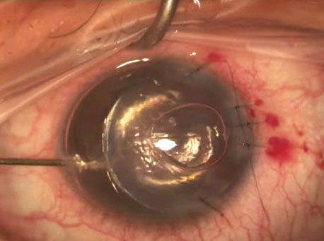 Although DSEK has proven itself to be a quantum leap up from penetrating keratoplasty, endothelial cell loss remains a concern. Image courtesy of James Lewis, MD. 