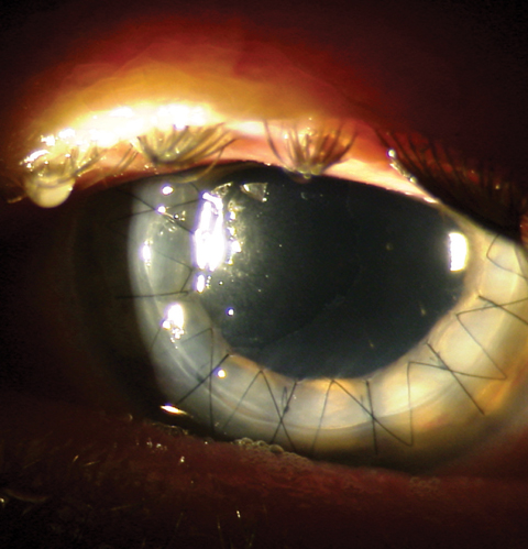 Though still a rare occurrence, corneal ulcers brought on through contact lens wear led to penetrating keratoplasty more often than those arising from refractive surgery. Image courtesy of Mitch Ibach, OD.
