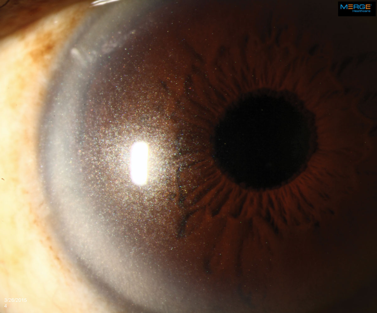 The appearance of crystalline keratopathy in the cornea can range from looking like needles to small crystals or dust-like particles.