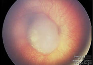 Retinoblastoma patients may fare better from enucleation than eye-preserving therapies.