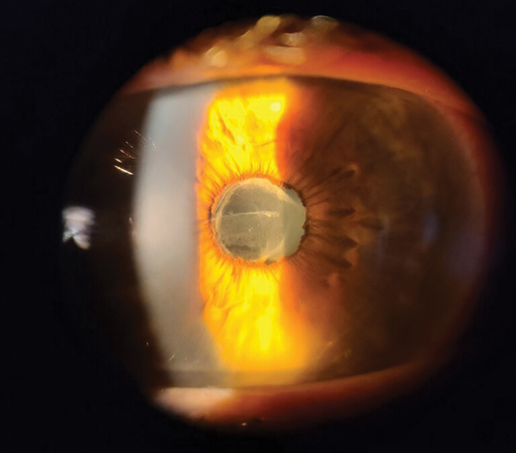 Only when the cells and flare from uveitis resolve dramatically should ODs begin a slow taper of the steroid to prevent rebound.