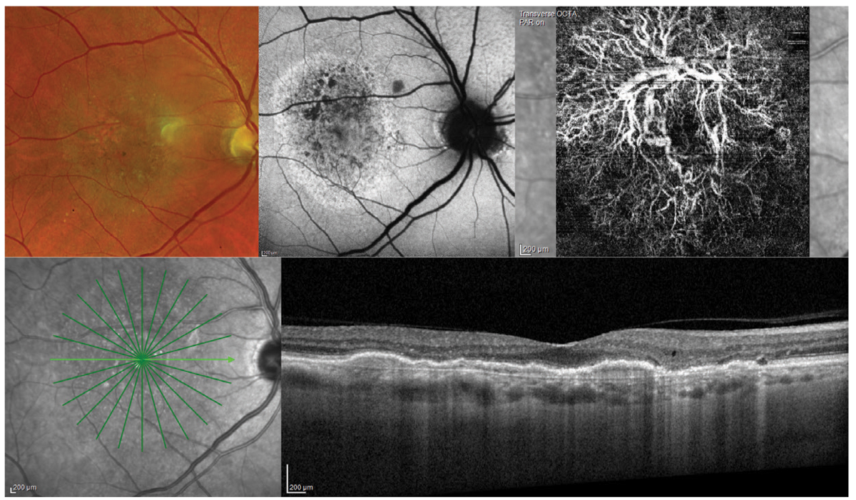 Fig. 1. AMD patient with a disc-shaped region of pigmentary abnormalities on clinical exam, also demonstrated on the FAF (top middle image). OCT shows an elongated pigment epithelial detachment (PED) with minimal evidence of overlying exudation such as subretinal or intraretinal fluid. OCT-A (top right), however, shows an extensive choroidal neovascular network underlying the PED.