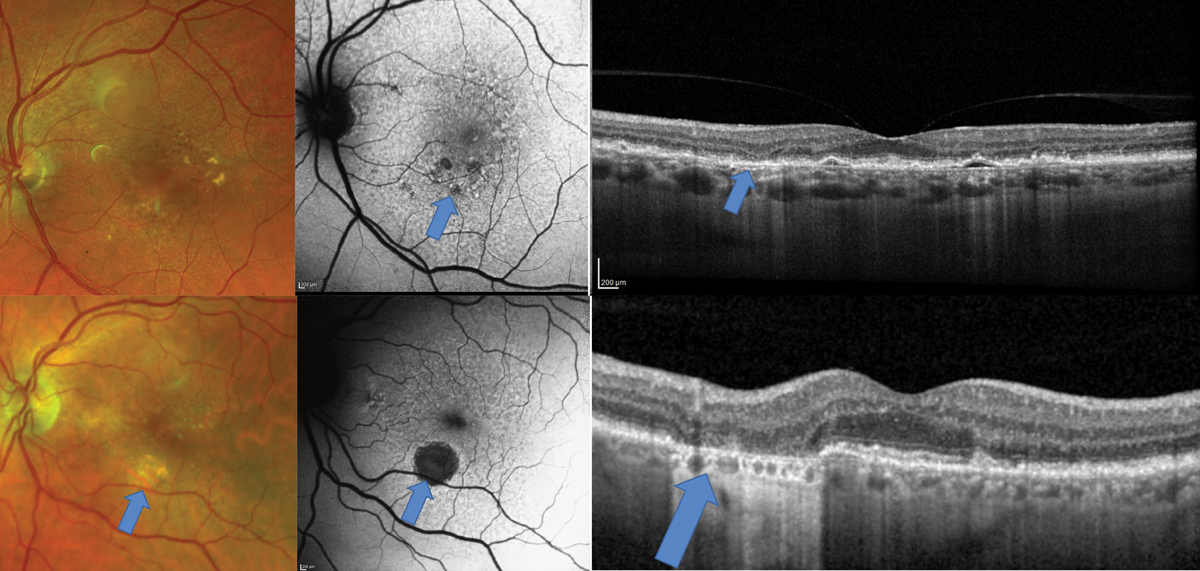Fig. 2. Top images show a patient who would be categorized clinically as intermediate-stage AMD due to pigmentary changes. The FAF shows diffuse alterations to the RPE with areas of hypo-autofluorescence suggestive of early GA. In this region on the OCT, there is atrophy of the outer nuclear layer also suggestive of early GA. The bottom images show a patient with a frank area of GA that is visible clinically but seen even more easily with FAF.