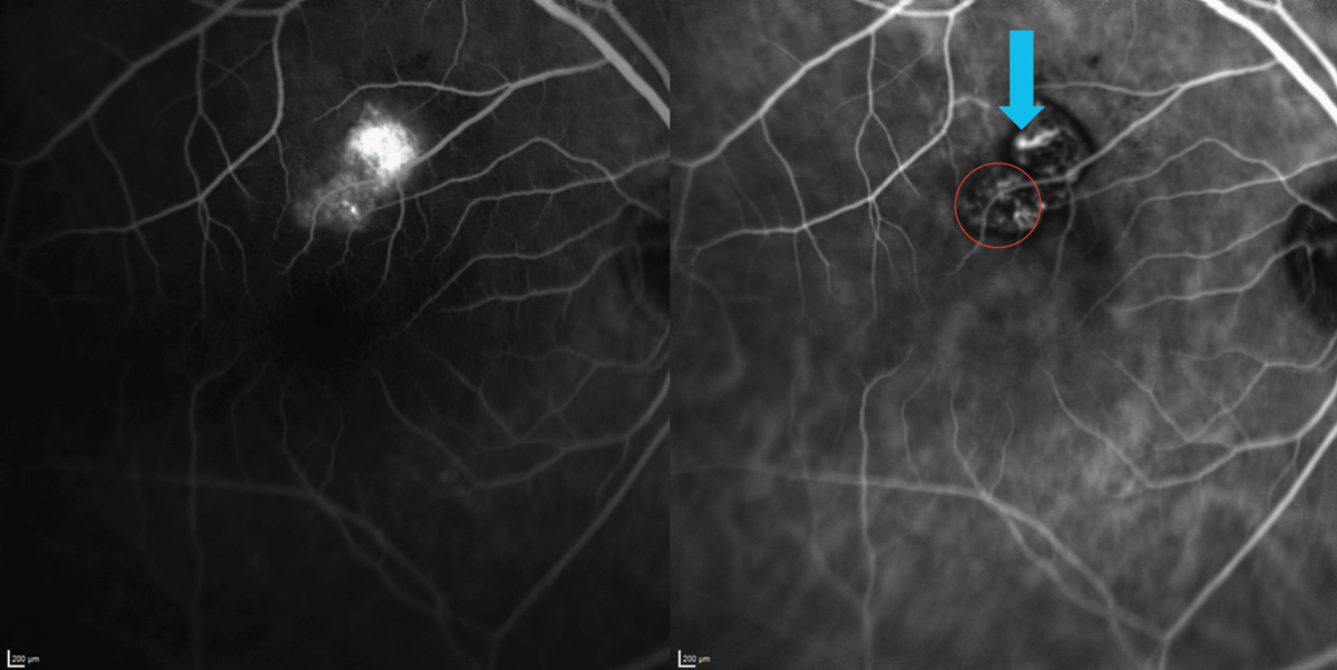 Fig. 10. FA doesn’t give a detailed view of choroidal pathology (left) due to the molecule’s small size and ability to seep through choriocapillaris fenestrations, as well as a shorter excitation wavelength that gets blocked by the RPE. ICGA (right) employs a larger molecule that is protein-bound and excites in the infrared range, therefore reaching the deeper structure. In this patient with polypoidal choroidal vasculopathy, or aneurysmal type 1 neovascularization, the BNVs can be seen with a dendritic-like pattern (red circle). The “hot-spot” (blue arrow), which is pathognomonic for PCV, denotes the condition’s polyp. These findings are not well-visualized with FA (left). 