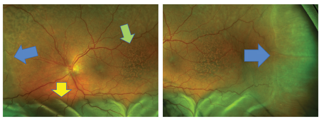 Fig. 15. Choroidal detachment in the left eye (blue arrow). Serous RD (yellow arrow) and pigmentary changes (green arrow) are also shown.