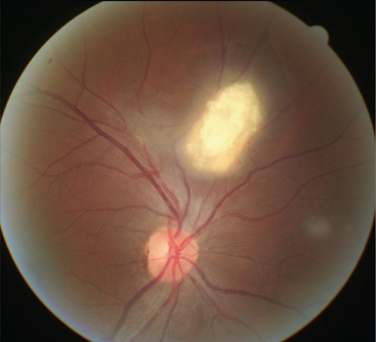 Fig. 2. The most suggestive ocular finding in TSC is retinal astrocytic hamartoma.