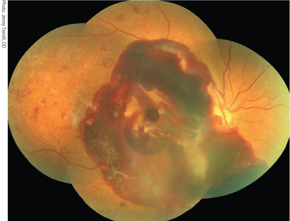 Fig. 3. Severe vision loss due to PDR more common in diabetic patients with chronic kidney disease.