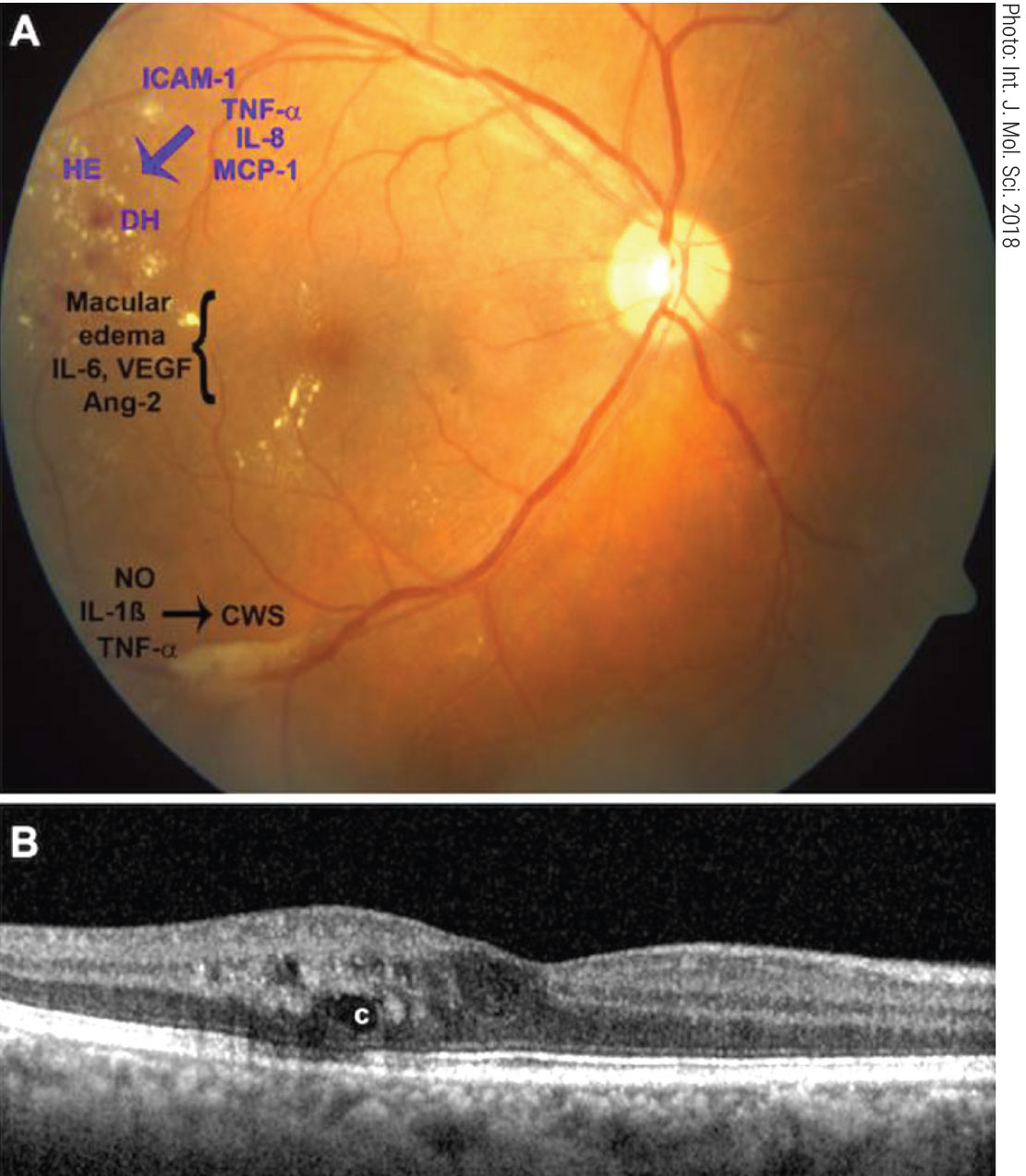 Fig. 4. Interferon retinopathy clinical appearance and pro-inflammatory cytokines (A). Exudates and cystic edema on OCT (B).