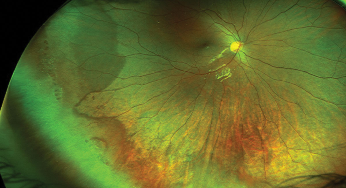 A highly myopic fundus may be best observed through ultra-widefield fundus imaging, which can capture portions of the eye that conventional imaging cannot. Photo: Mohammad Rafieetary, OD. 