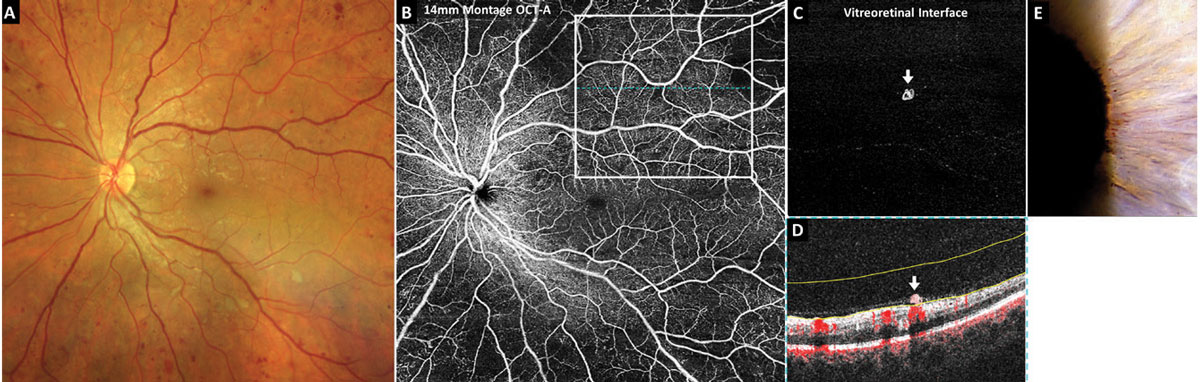 Fig. 1. OCT-A of subtle proliferative diabetic retinopathy.