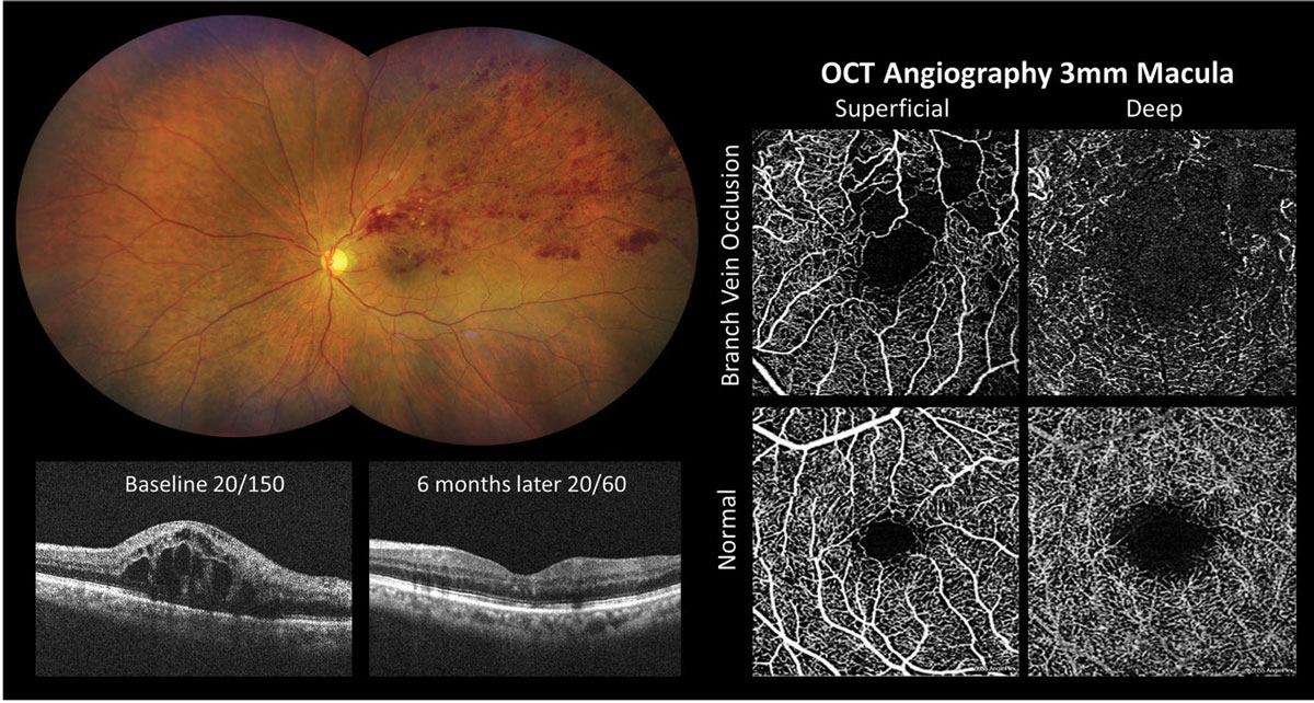 Fig. 2. OCT-A detection of macular ischemia in branch retinal vein occlusion.