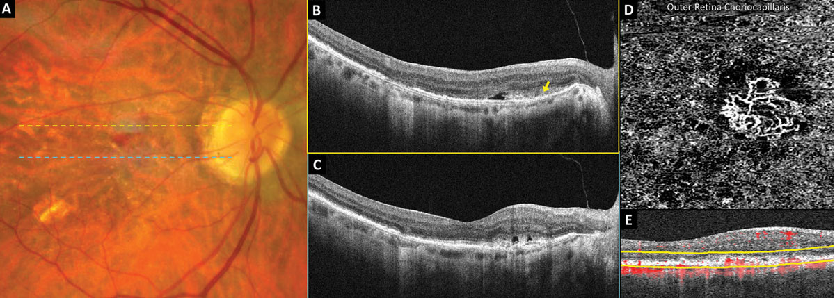 Fig. 4. OCT-A detection of neovascular AMD.