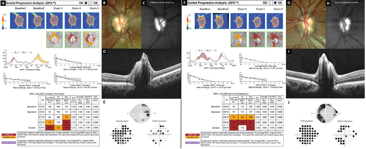 Fig. 8. Optic nerve and RNFL progression analysis demonstrating loss of the nerve fiber layer in optic nerve head drusen.