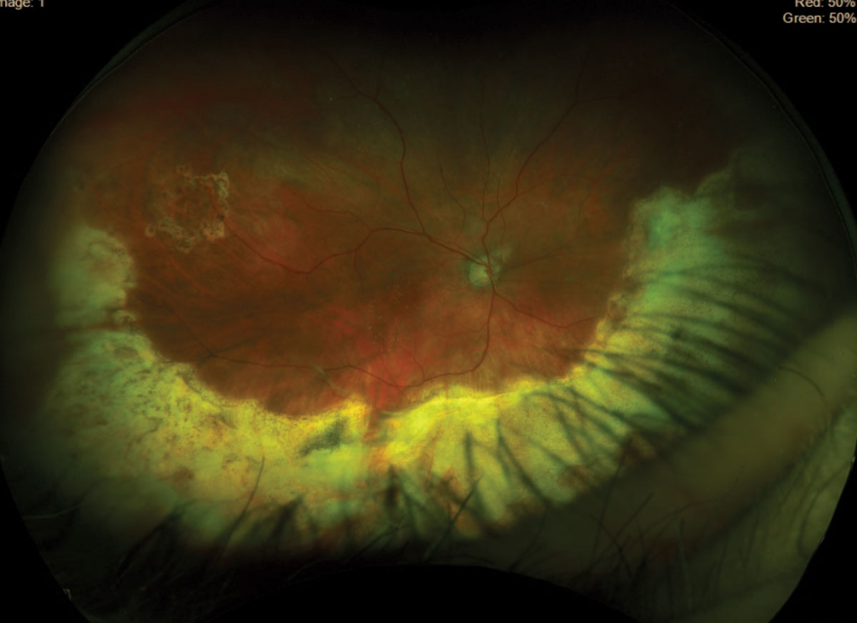Fig. 3. Inferior retinal detachment was found in the right eye.