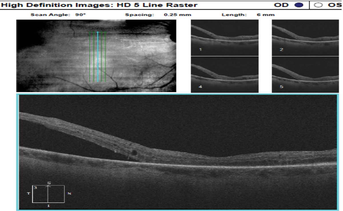 Fig. 4. OCT of the right eye confirmed SRF.