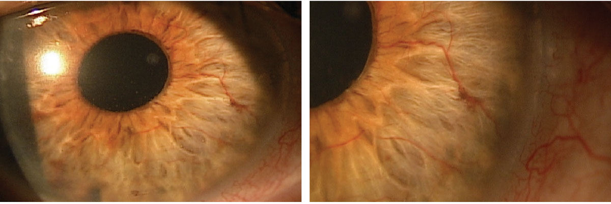 Figs. 1 and 2. Neovascularization of iris (NVI) was found during the slit lamp exam.