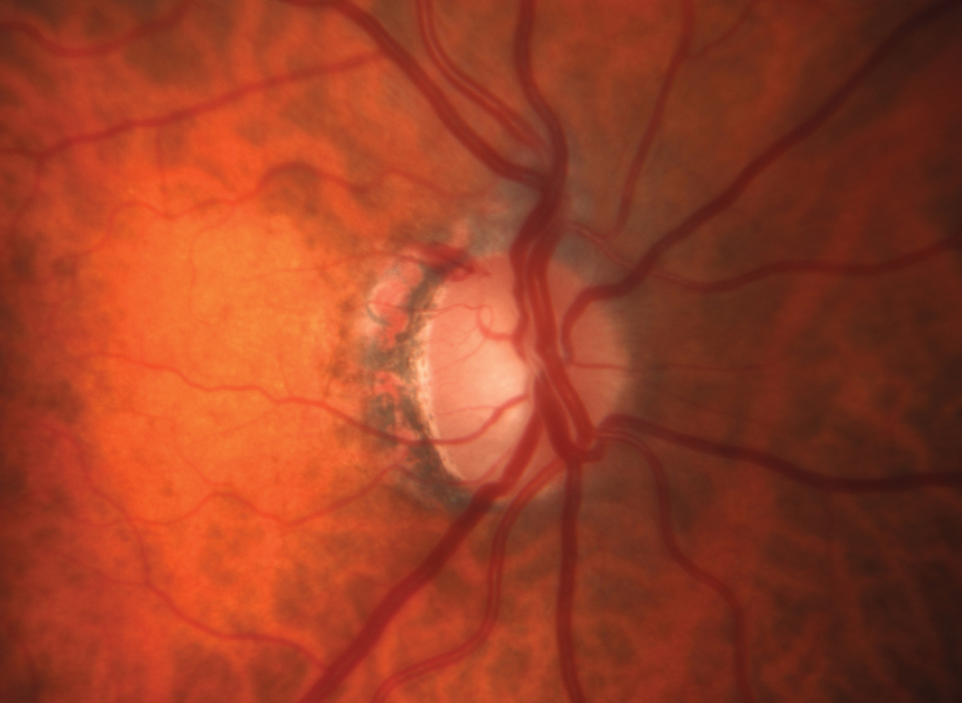 Glaucoma was the only condition in this study to be associated with cognitive decline. Photo: Michael Chaglasian, OD, and Sarah B. Klein, OD. 