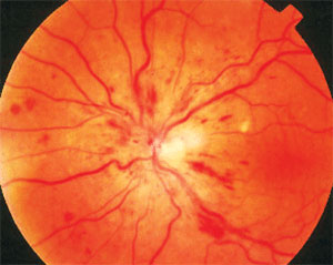 Aflibercept performed slightly better than ranibizumab for treating eyes with CRVO in this study. Photo: Joseph W. Sowka, OD, and Alan G. Kabat, OD. 