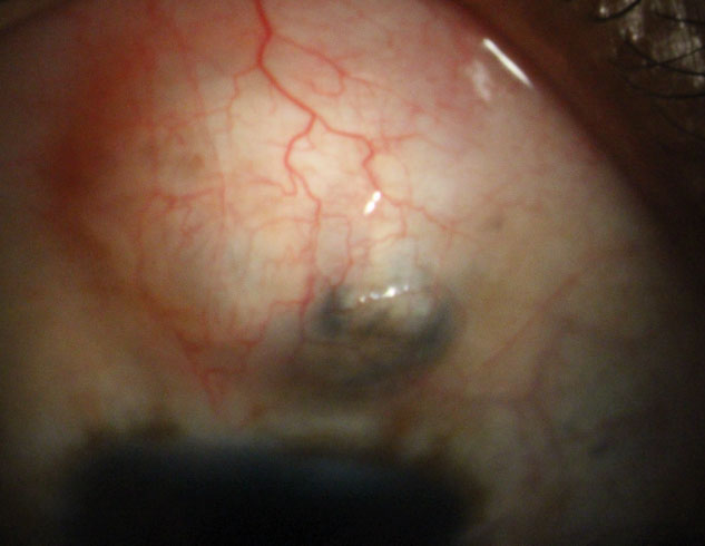 Patients with concerns about glaucoma surgery cost may want to choose a more conventional surgical option as opposed to a newer MIGS procedure. Photo: Justin Schweitzer, OD. Click image to enlarge.